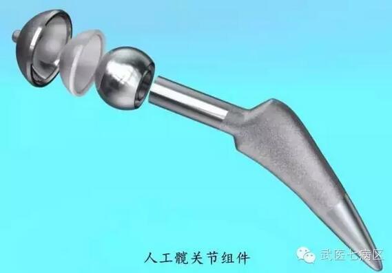 髋关节置换的早期材料研究与应用探索